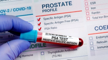 Ang Aking PSA ay Mataas: Nangangahulugan ba Iyan na Ako ay May Prostate Cancer?