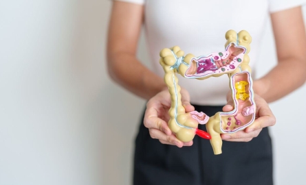Colon Polyps: Kanser ba Sila?