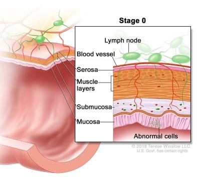 colorectal cancer stage 0 ilustrasyon