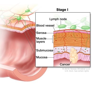 colorectal cancer stage 1 ilustrasyon
