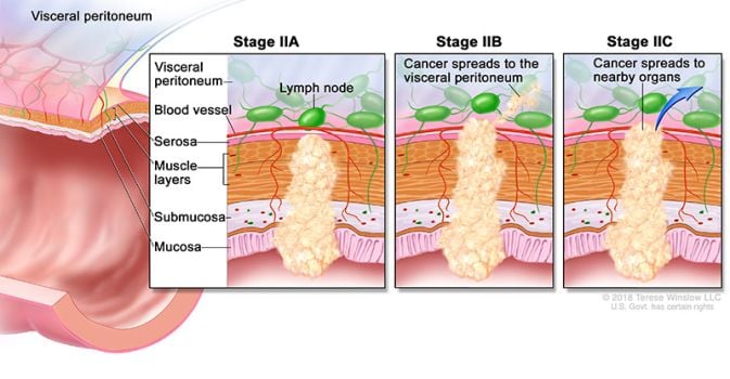 colorectal cancer stage 2 ilustrasyon