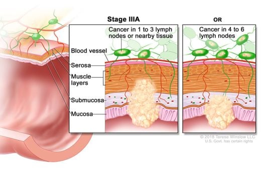 stage 3a colon at rectal cancer