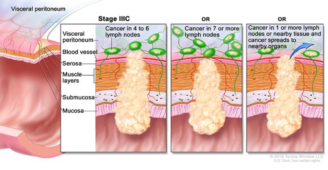 stage 3c colon at rectal cancer