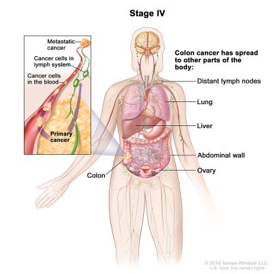 colorectal cancer stage 4 na paglalarawan