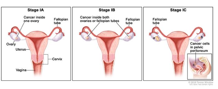 stage 1 ovarian cancer 1a 1b 1c ovarian cancer stage