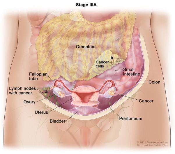 ovarian cancer stage3a