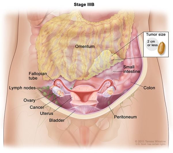 stage ovarian cancer 3b