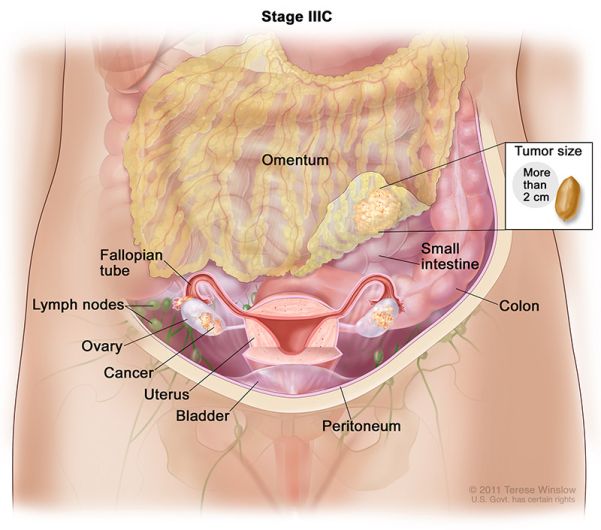 ovarian cancer stage 3c